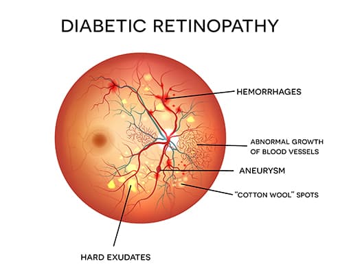 Diagram of Diabetic Retinopathy